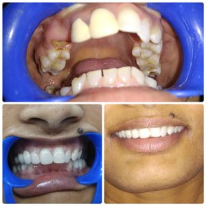 Top 10 Dentists in Kondapur Hyderabad, Secundrabad India, Excellent Dentist in India