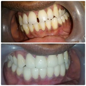 Best talanted dentist in kondapur Dental Hospital and Secundrabad India