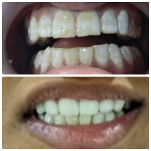 Kims dentists are best dentest in Kondapur Hyderabad India
