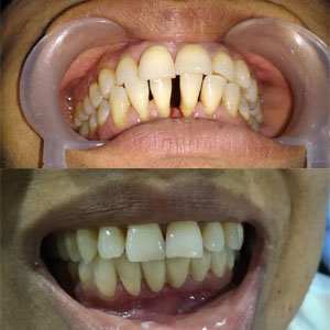 Kims dental hospital in Kondapur is giving best dental treatment for dental problems