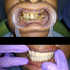 dental implants in Kondapur, Secundrabad India