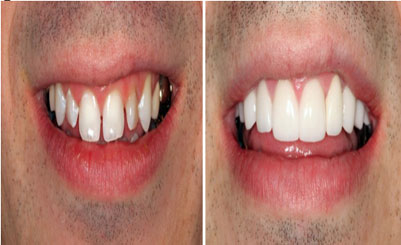 Kims dental hospital, best dental care, dental clinic Kondapur, dental implants Kondapur, dentist Kondapur, dentist in Kondapur, dental appointment in Kondapur, dental hospital Kondapur, best dental in India, best dental hospital in Hyderabad, best dental hospital in secundrabad